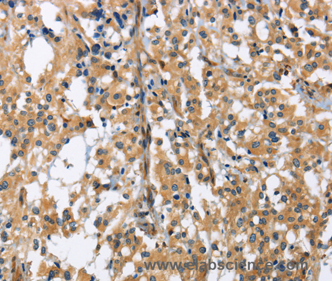 Immunohistochemistry of paraffin-embedded Human thyroid cancer tissue using GAB1 Polyclonal Antibody at dilution 1:40