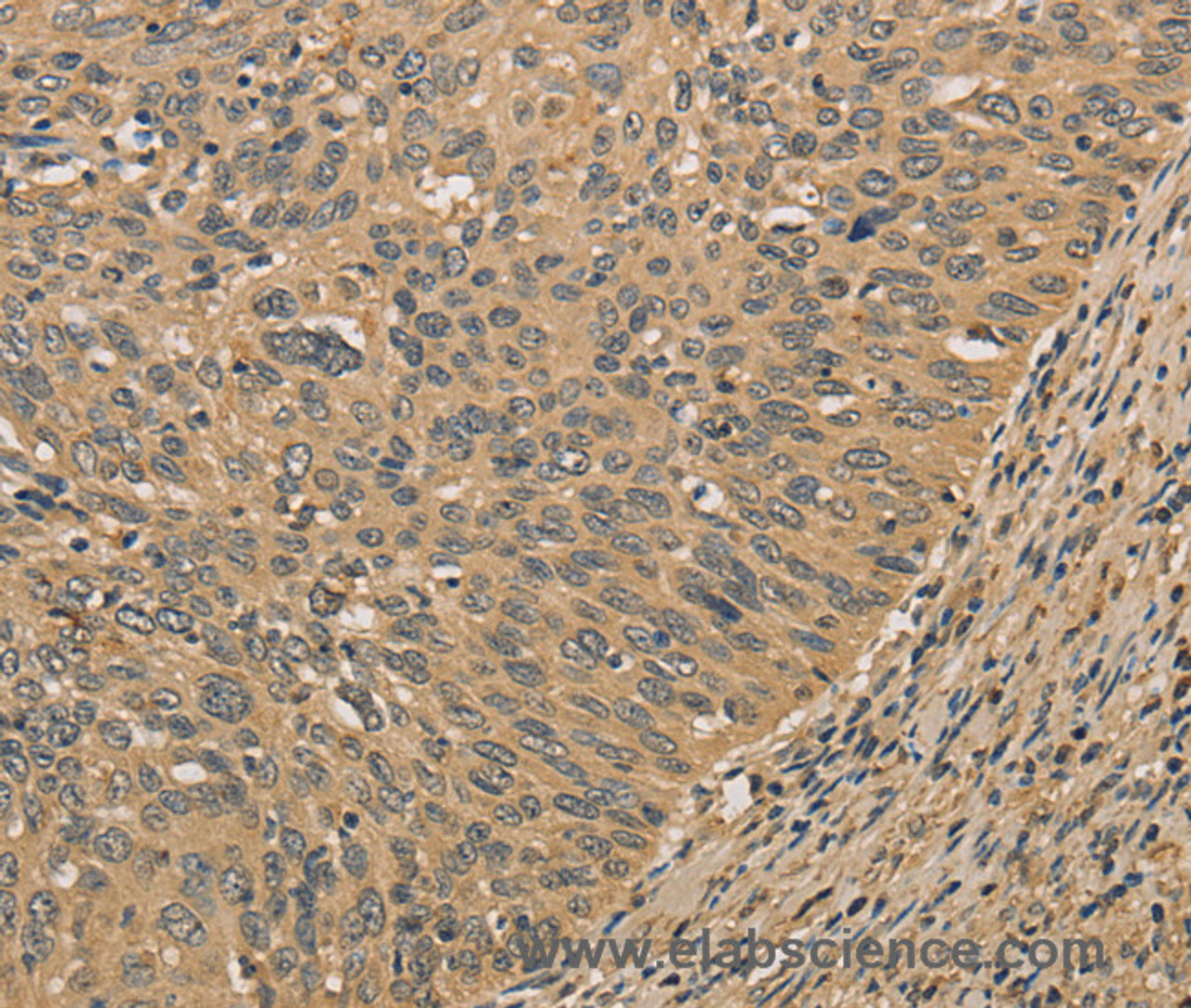 Immunohistochemistry of paraffin-embedded Human cervical cancer tissue using PRDM14 Polyclonal Antibody at dilution 1:30