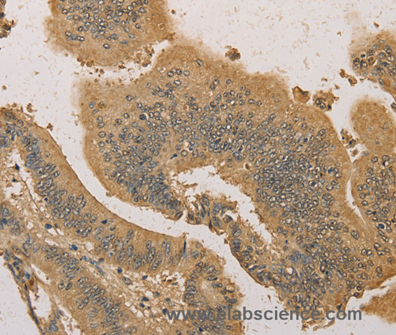 Immunohistochemistry of paraffin-embedded Human colon cancer tissue using PRDM14 Polyclonal Antibody at dilution 1:30