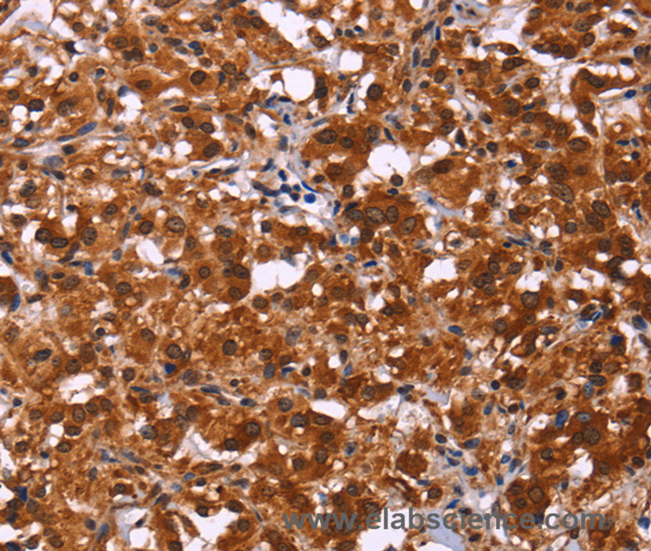 Immunohistochemistry of paraffin-embedded Human thyroid cancer tissue using ART5 Polyclonal Antibody at dilution 1:50