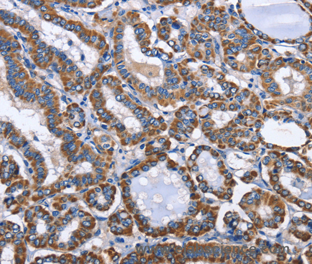 Immunohistochemistry of paraffin-embedded Human thyroid cancer using INTS10 Polyclonal Antibody at dilution of 1:50