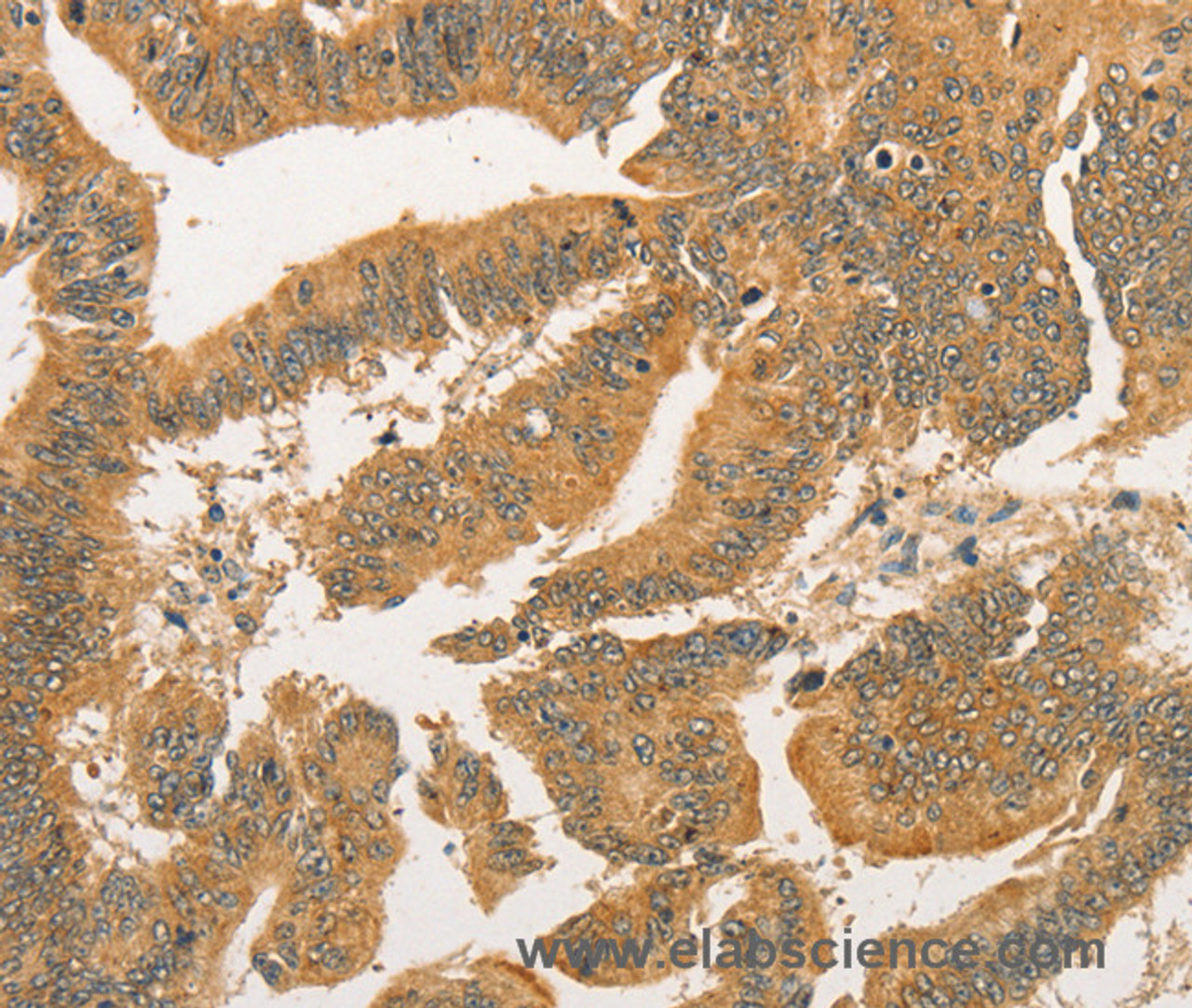 Immunohistochemistry of paraffin-embedded Human colon cancer tissue using BCL2L14 Polyclonal Antibody at dilution 1:40