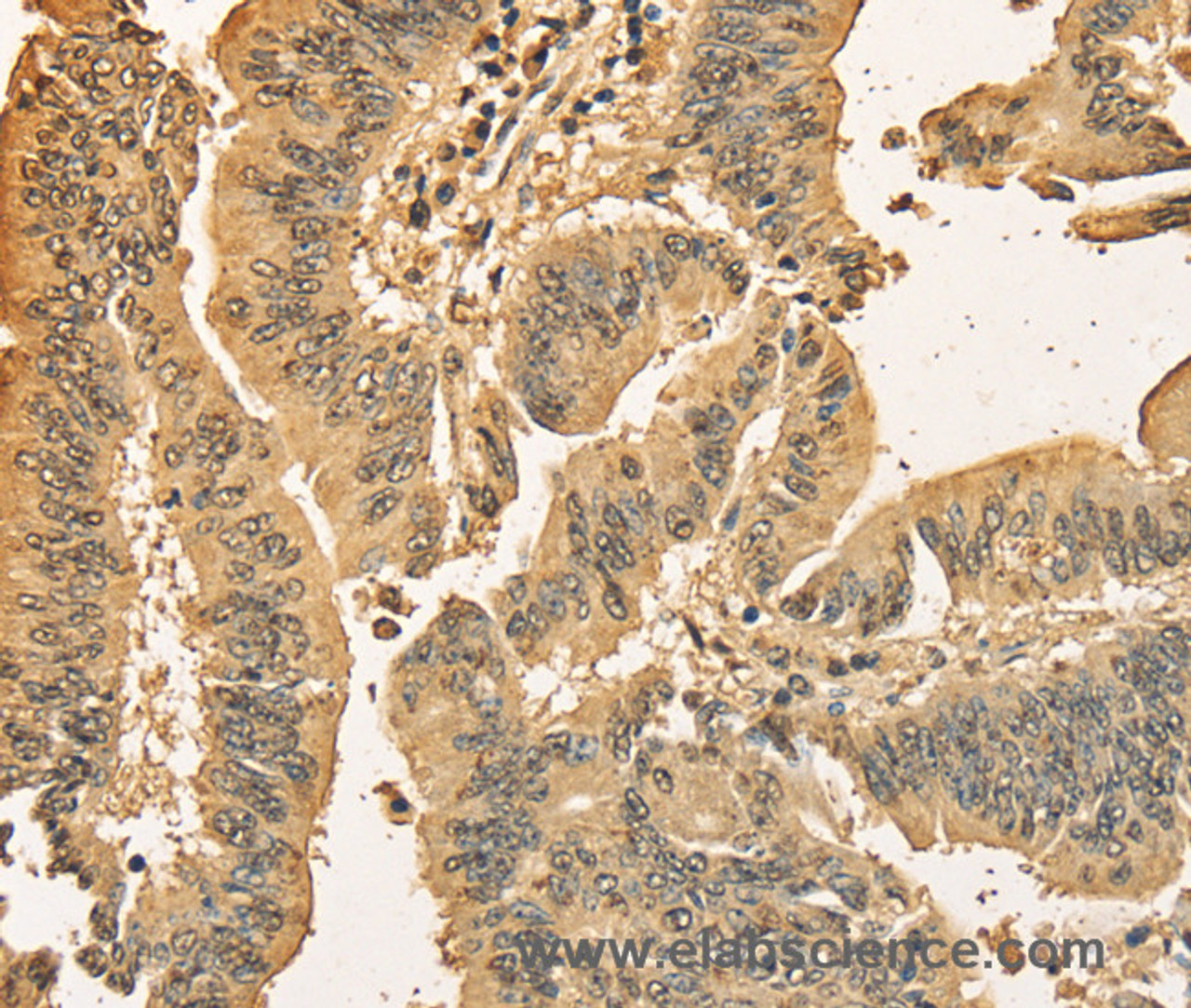 Immunohistochemistry of paraffin-embedded Human colon cancer using CDCA8 Polyclonal Antibody at dilution of 1:40