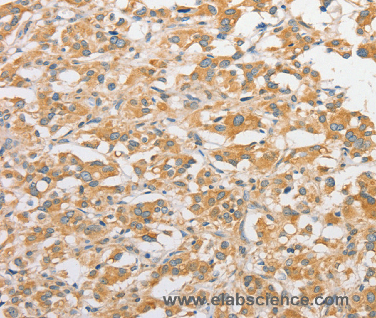 Immunohistochemistry of paraffin-embedded Human thyroid cancer tissue using TLR5 Polyclonal Antibody at dilution 1:30