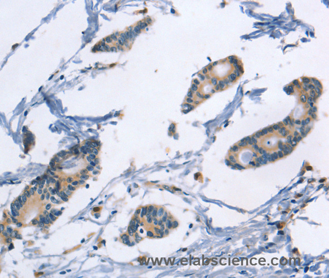 Immunohistochemistry of paraffin-embedded Human colon cancer tissue using TLR8 Polyclonal Antibody at dilution 1:40