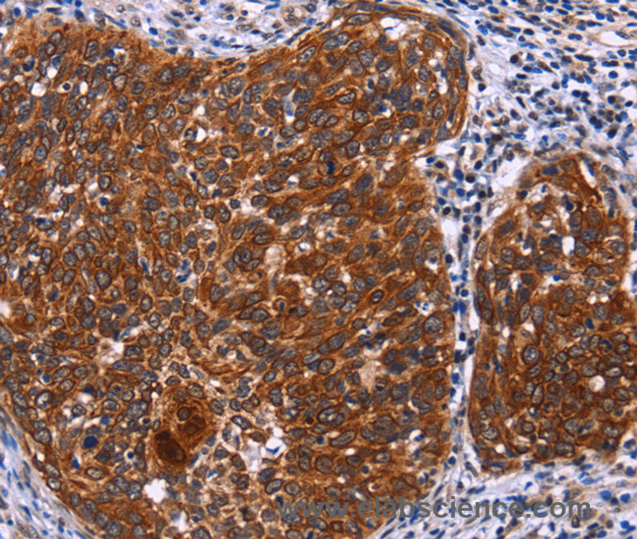 Immunohistochemistry of paraffin-embedded Human cervical cancer tissue using USP2 Polyclonal Antibody at dilution 1:40