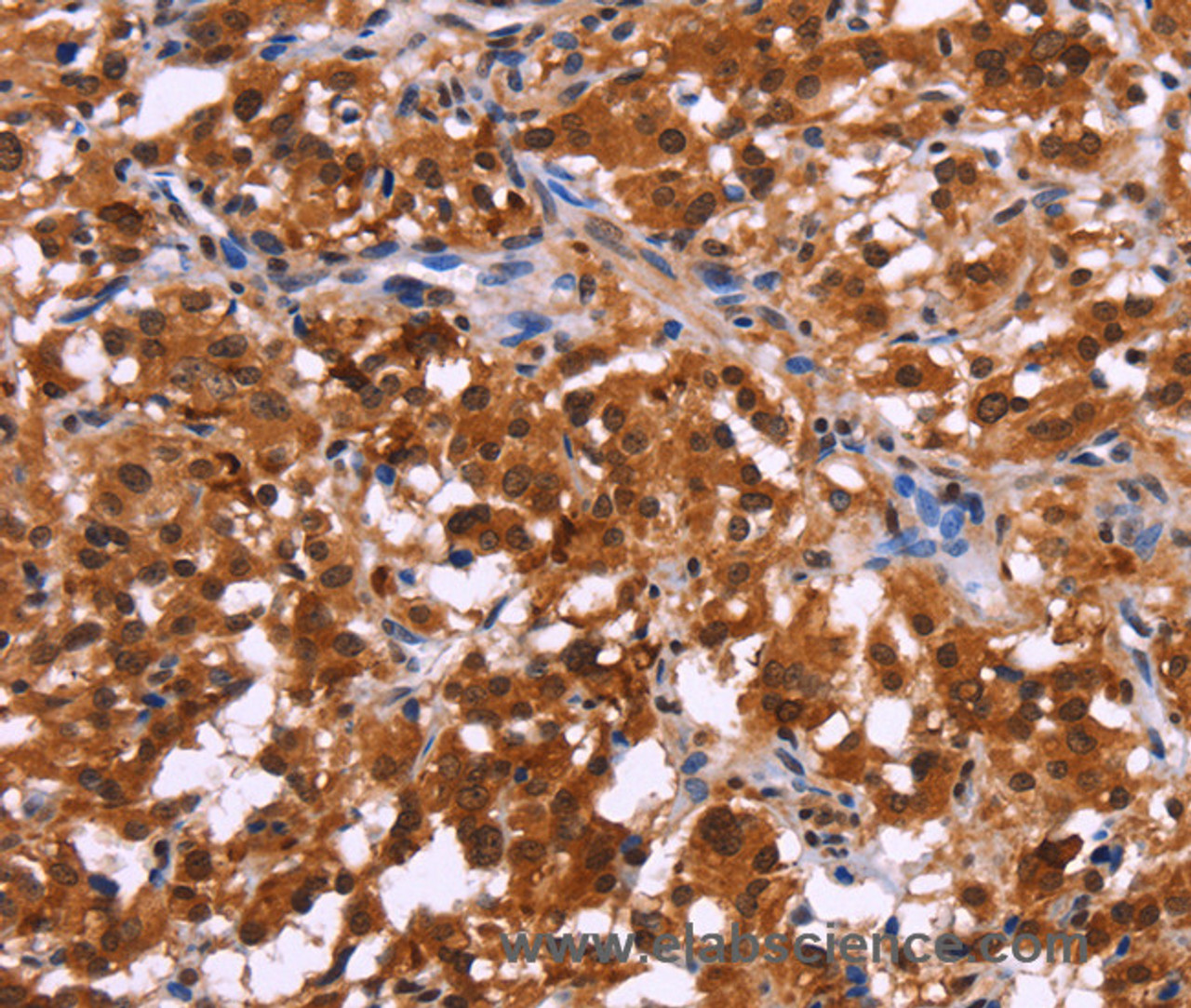 Immunohistochemistry of paraffin-embedded Human thyroid cancer tissue using USP2 Polyclonal Antibody at dilution 1:40