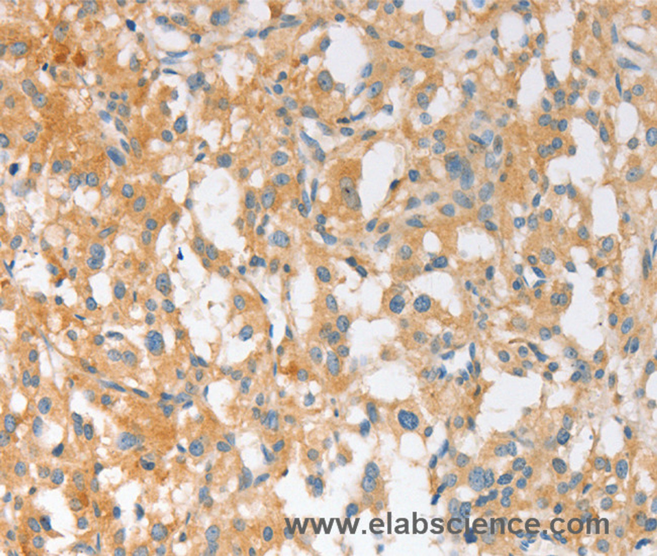 Immunohistochemistry of paraffin-embedded Human thyroid cancer using EPS15L1 Polyclonal Antibody at dilution of 1:30
