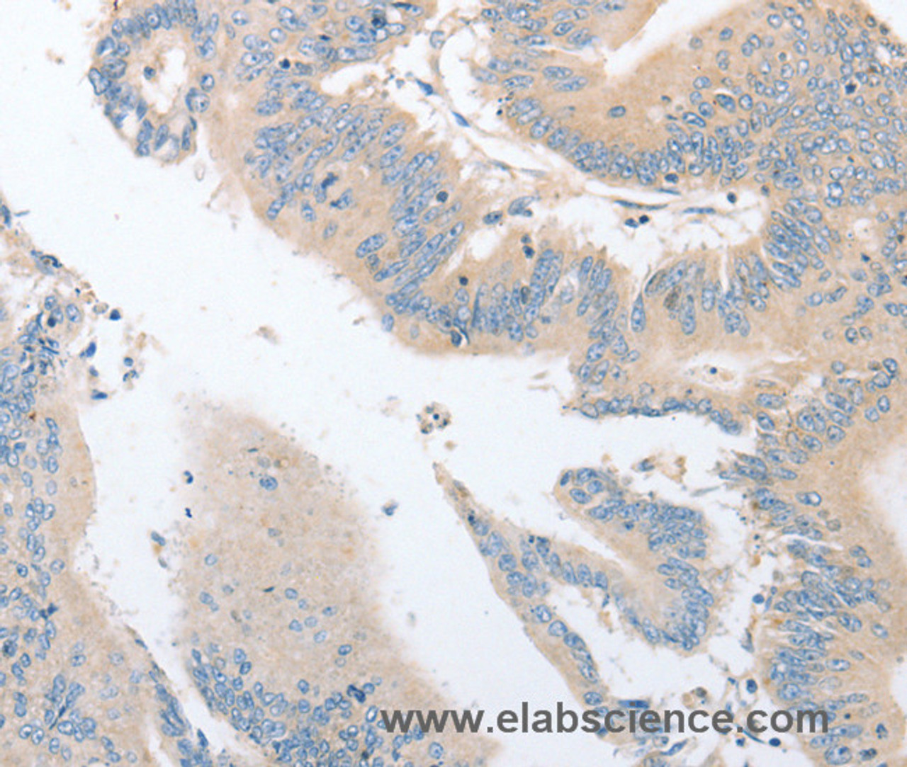 Immunohistochemistry of paraffin-embedded Human colon cancer using EPS15L1 Polyclonal Antibody at dilution of 1:30