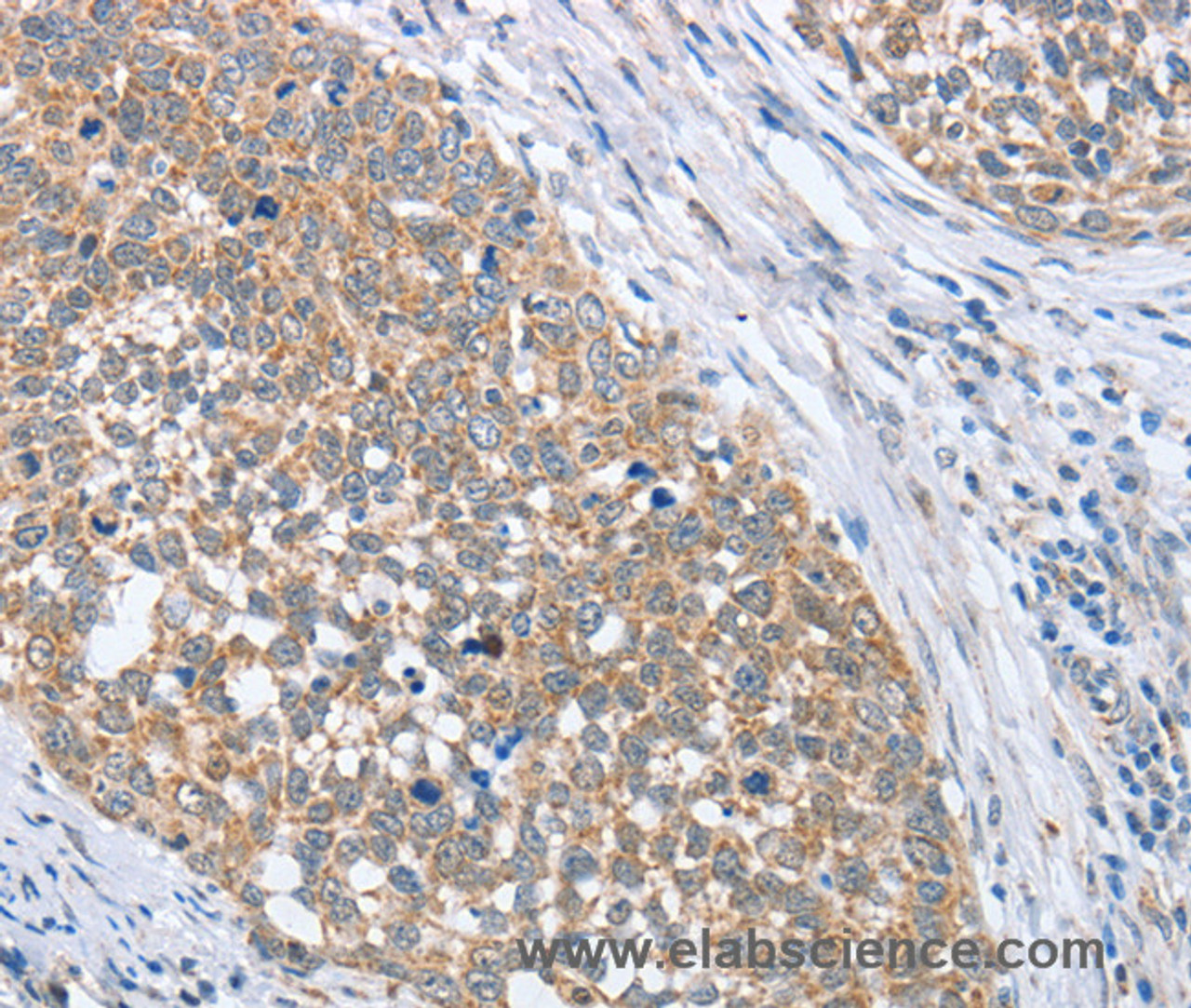 Immunohistochemistry of paraffin-embedded Human cervical cancer tissue using PAPSS1 Polyclonal Antibody at dilution 1:40
