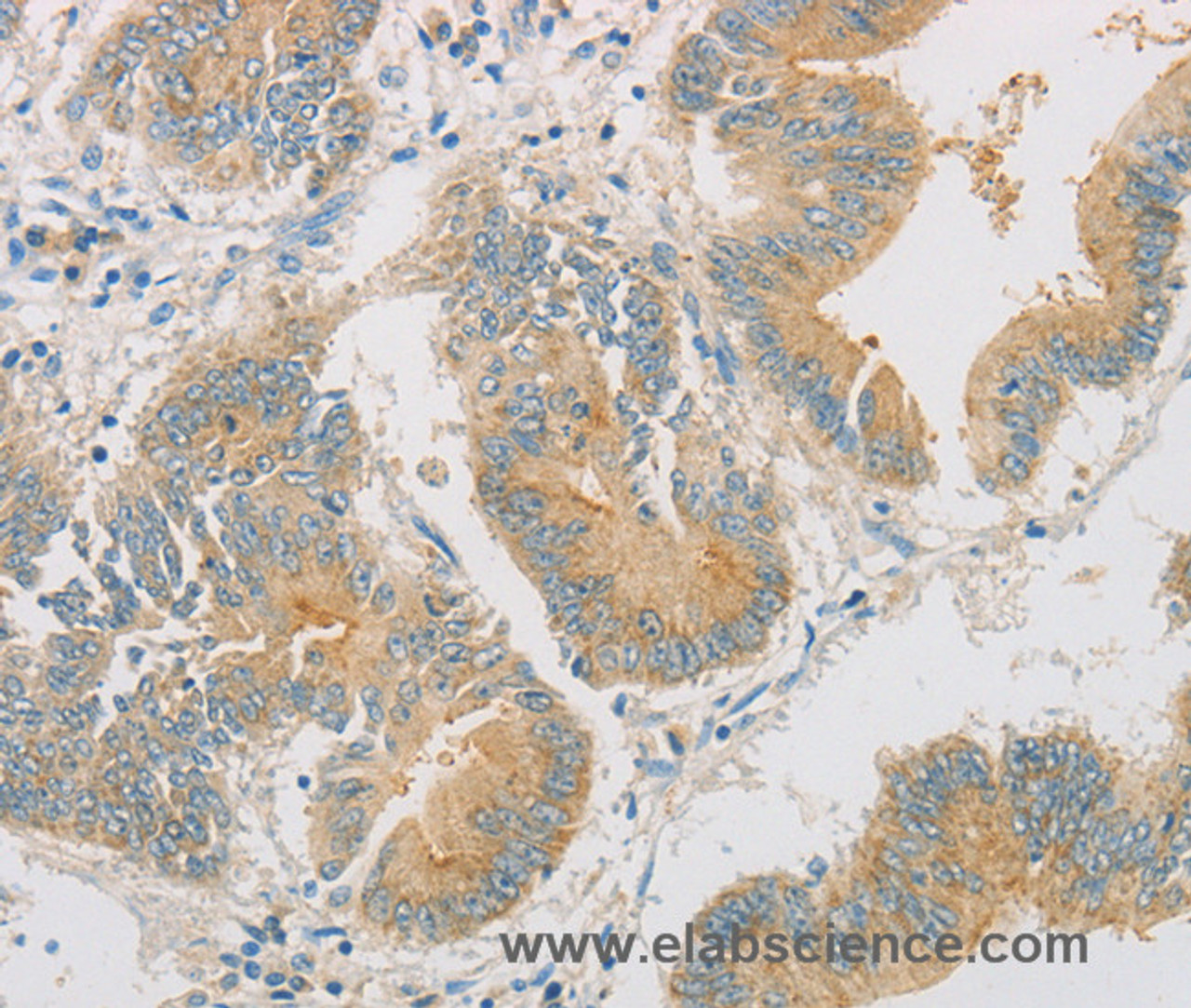 Immunohistochemistry of paraffin-embedded Human colon cancer tissue using ZWINT Polyclonal Antibody at dilution 1:50