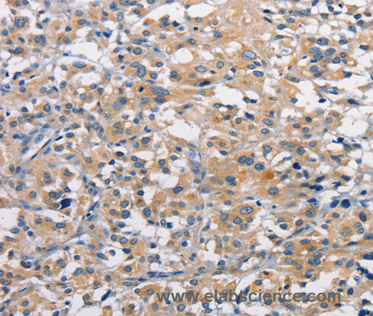 Immunohistochemistry of paraffin-embedded Human thyroid cancer using PKC epsilon Polyclonal Antibody at dilution of 1:50