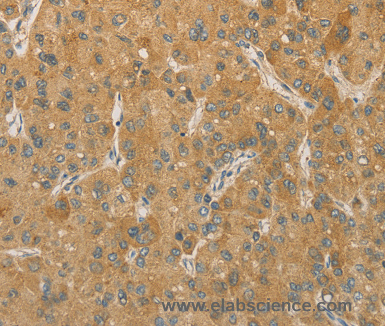 Immunohistochemistry of paraffin-embedded Human liver cancer tissue using PRPSAP1 Polyclonal Antibody at dilution 1:80