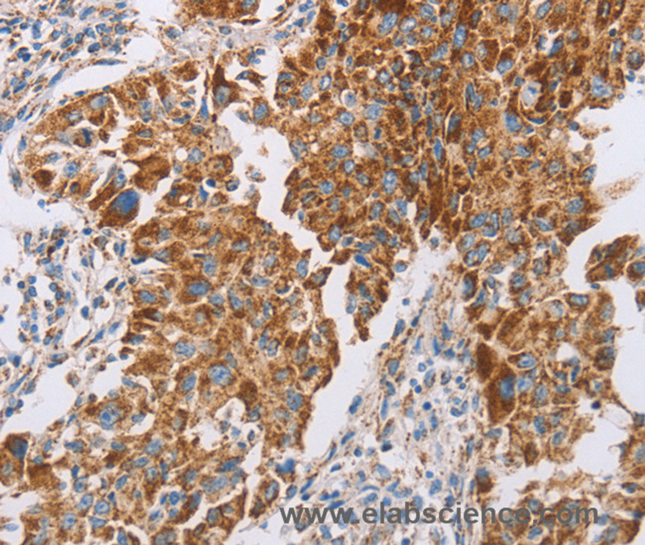 Immunohistochemistry of paraffin-embedded Human lung cancer tissue using GUCY1A3 Polyclonal Antibody at dilution 1:40