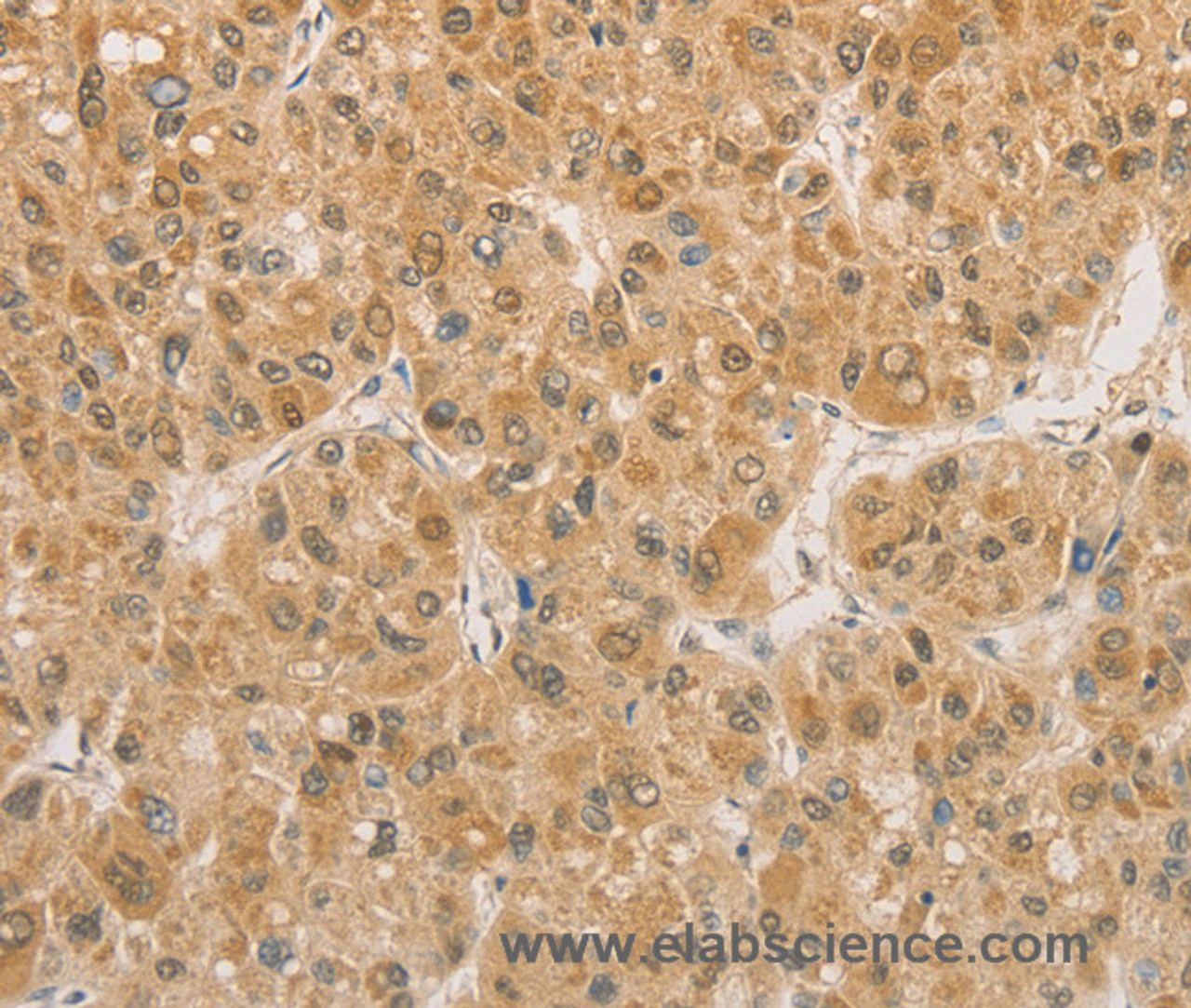 Immunohistochemistry of paraffin-embedded Human liver cancer using PGK2 Polyclonal Antibody at dilution of 1:50