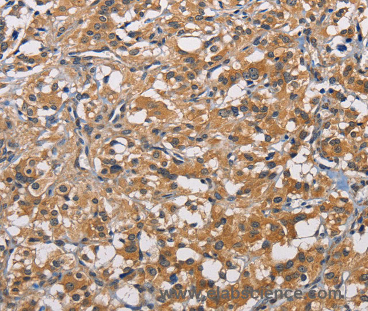 Immunohistochemistry of paraffin-embedded Human thyroid cancer tissue using PIKFYVE Polyclonal Antibody at dilution 1:50