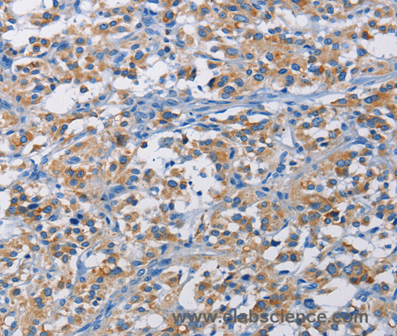 Immunohistochemistry of paraffin-embedded Human thyroid cancer tissue using RICTOR Polyclonal Antibody at dilution 1:50
