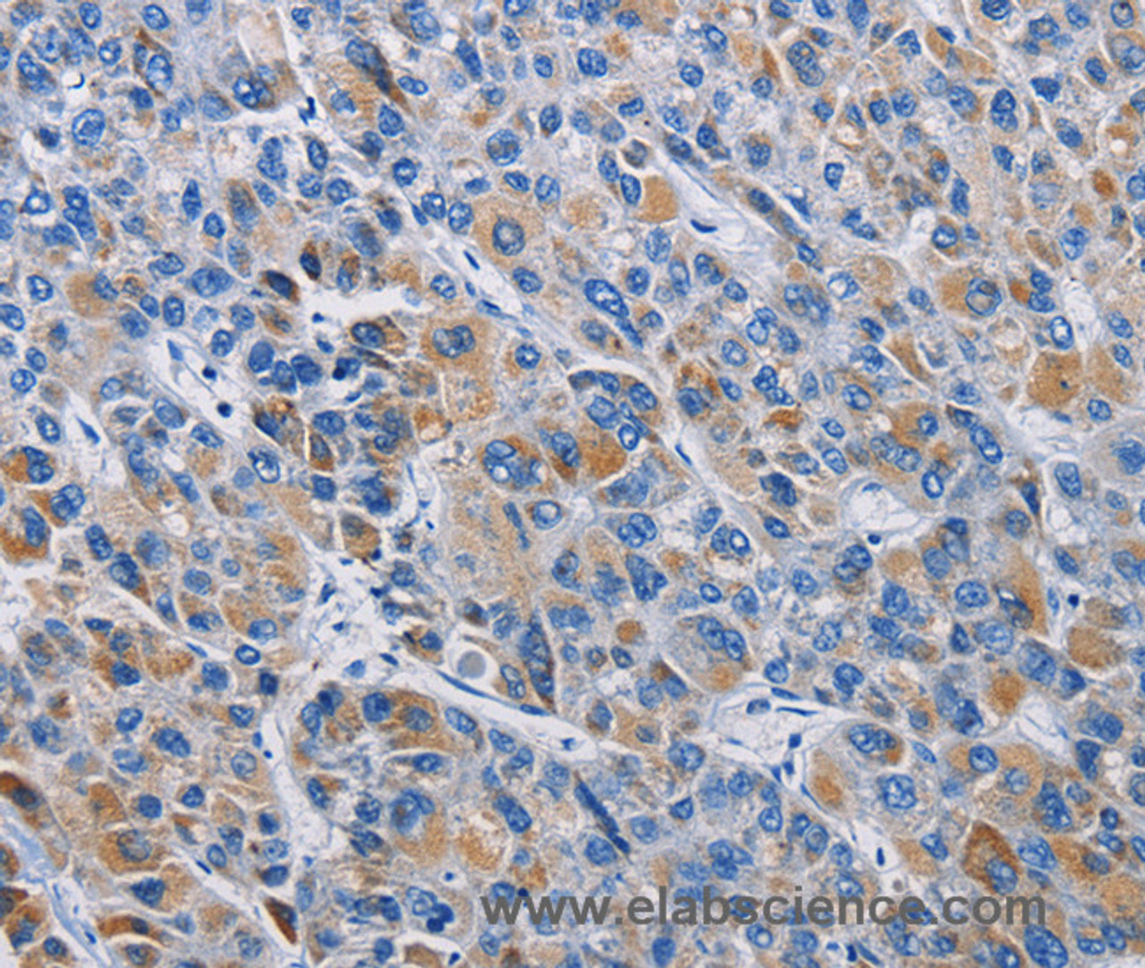 Immunohistochemistry of paraffin-embedded Human liver cancer tissue using RICTOR Polyclonal Antibody at dilution 1:50