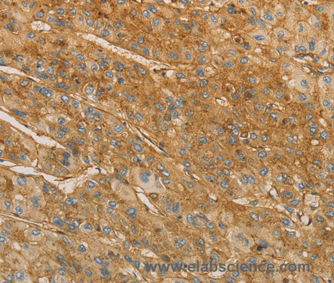 Immunohistochemistry of paraffin-embedded Human liver cancer tissue using VTN Polyclonal Antibody at dilution 1:40