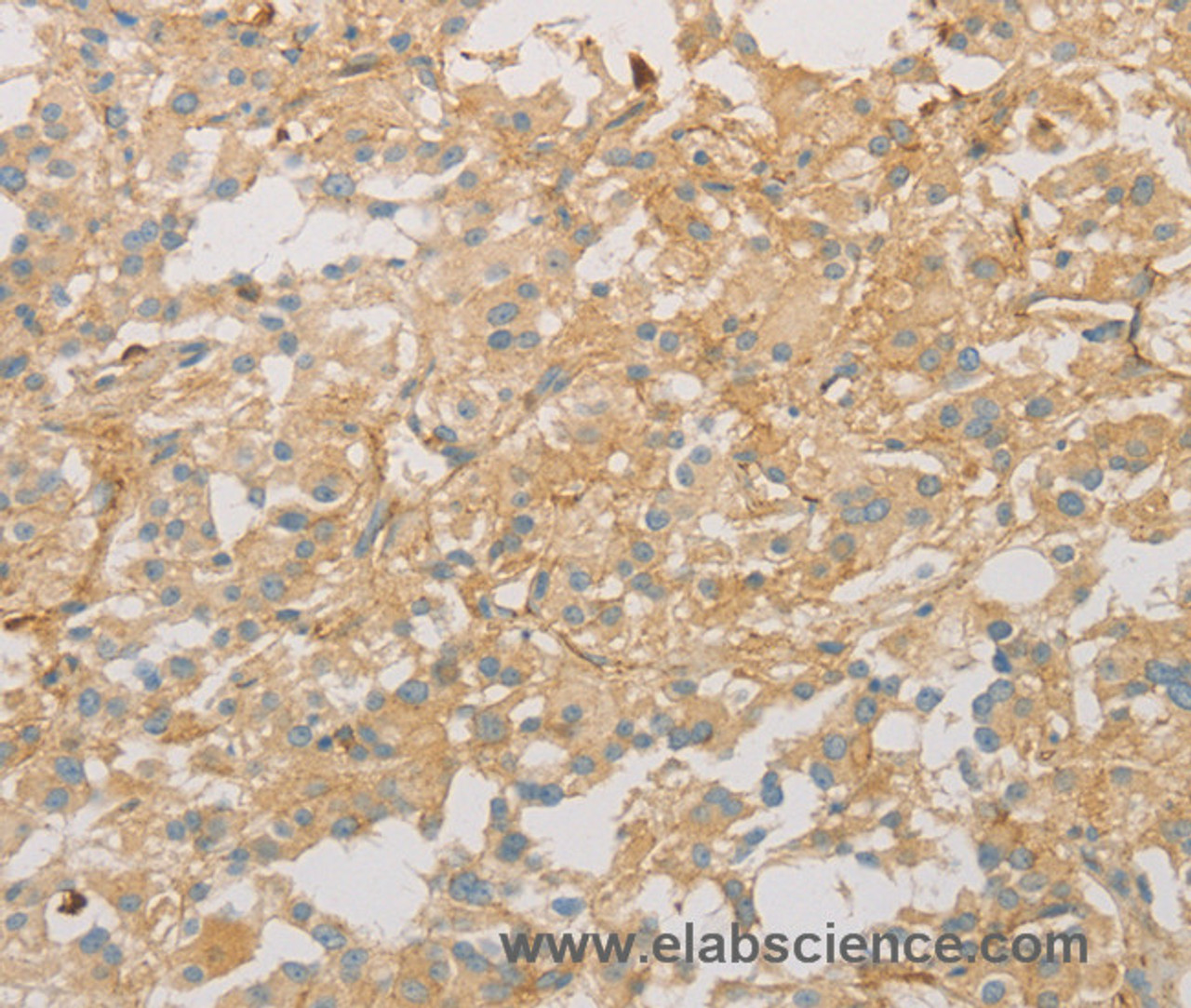 Immunohistochemistry of paraffin-embedded Human thyroid cancer tissue using VTN Polyclonal Antibody at dilution 1:40