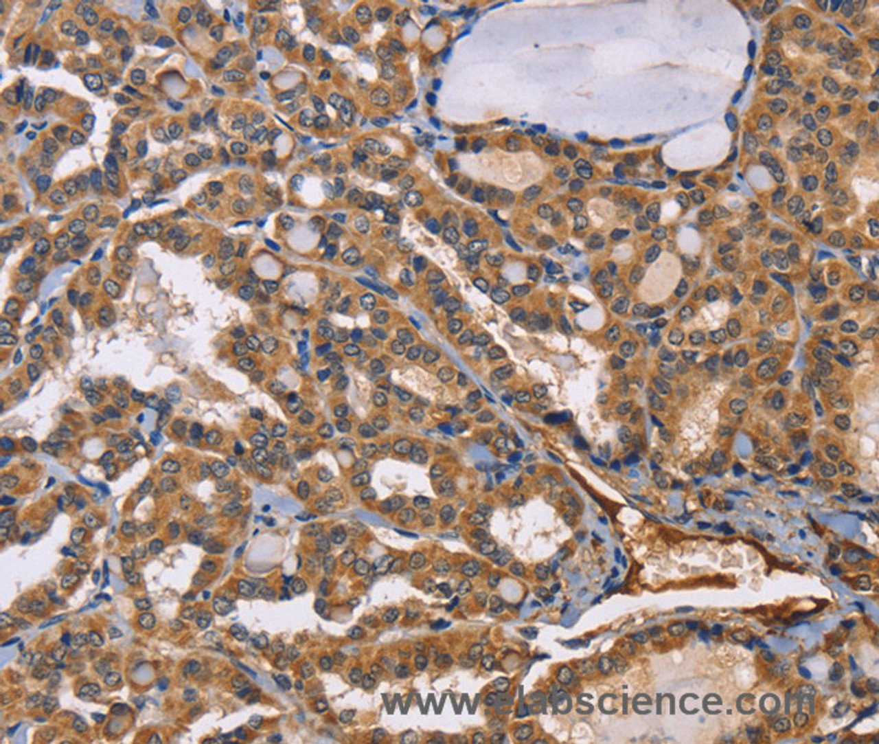 Immunohistochemistry of paraffin-embedded Human thyroid cancer tissue using EPHB6 Polyclonal Antibody at dilution 1:50