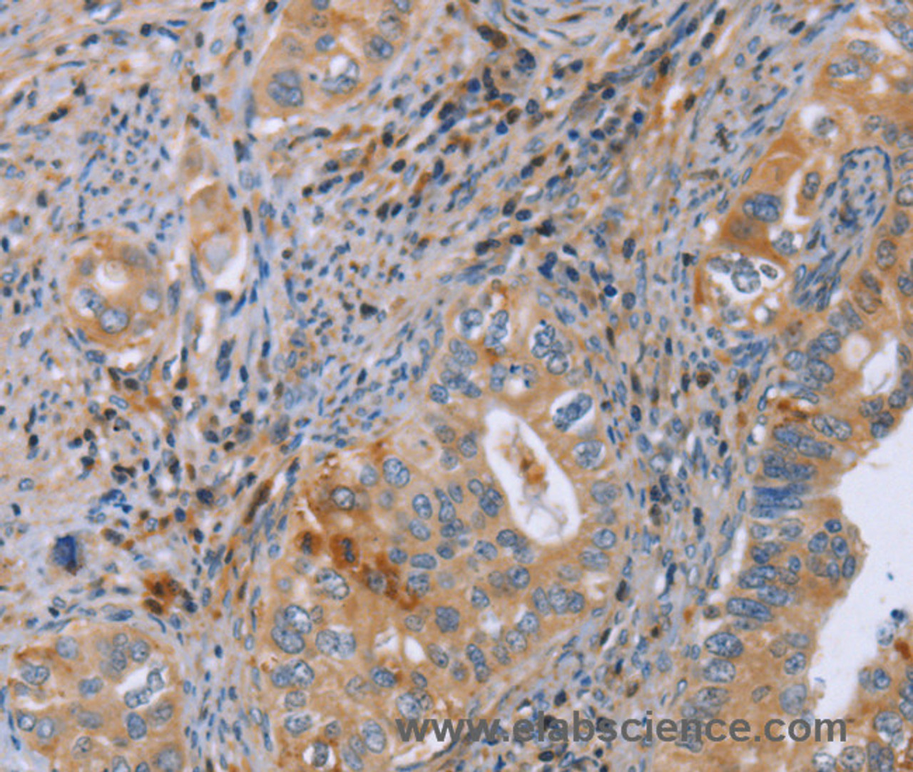 Immunohistochemistry of paraffin-embedded Human cervical cancer using GMFG Polyclonal Antibody at dilution of 1:50