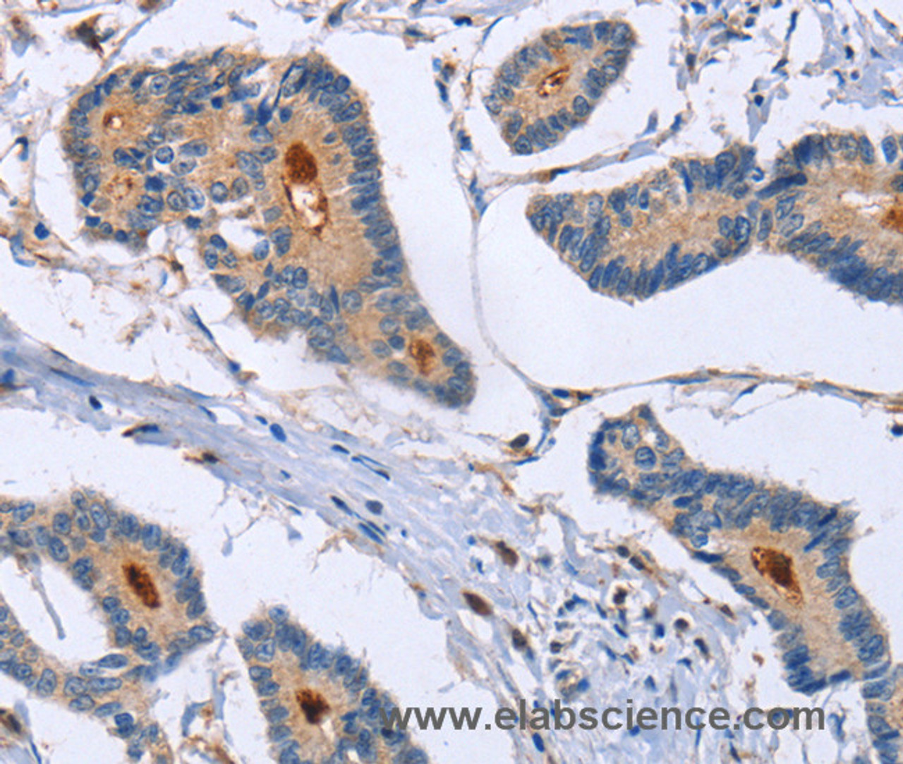 Immunohistochemistry of paraffin-embedded Human colon cancer using GMFG Polyclonal Antibody at dilution of 1:50