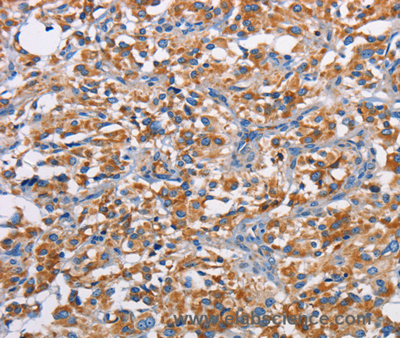 Immunohistochemistry of paraffin-embedded Human thyroid cancer tissue using PIM2 Polyclonal Antibody at dilution 1:40