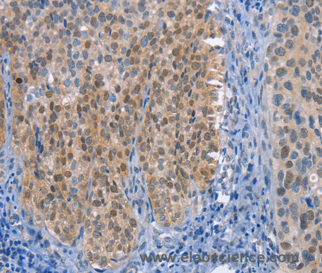 Immunohistochemistry of paraffin-embedded Human cervical cancer tissue using UCK1 Polyclonal Antibody at dilution 1:50