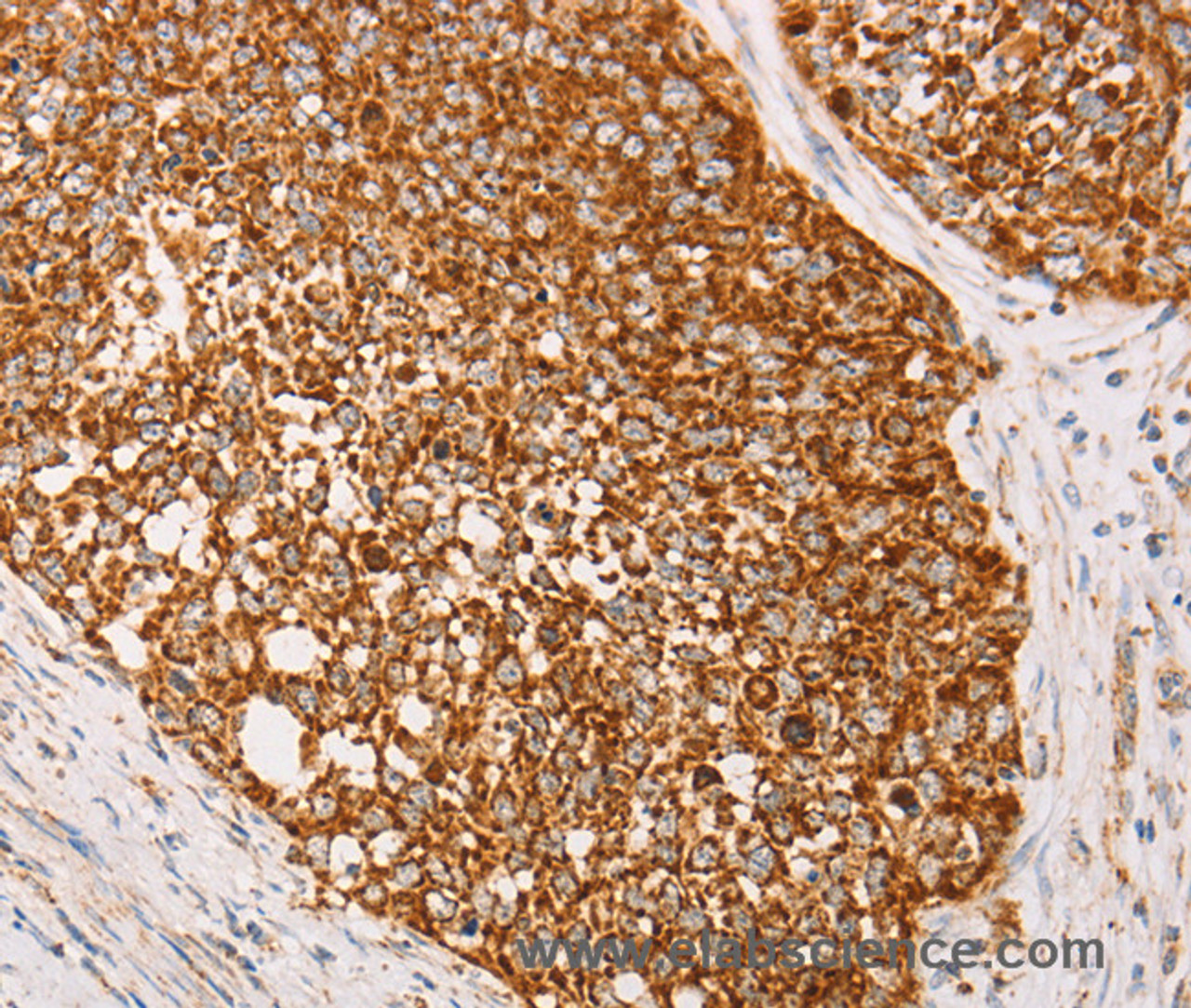 Immunohistochemistry of paraffin-embedded Human cervical cancer using AK2 Polyclonal Antibody at dilution of 1:40