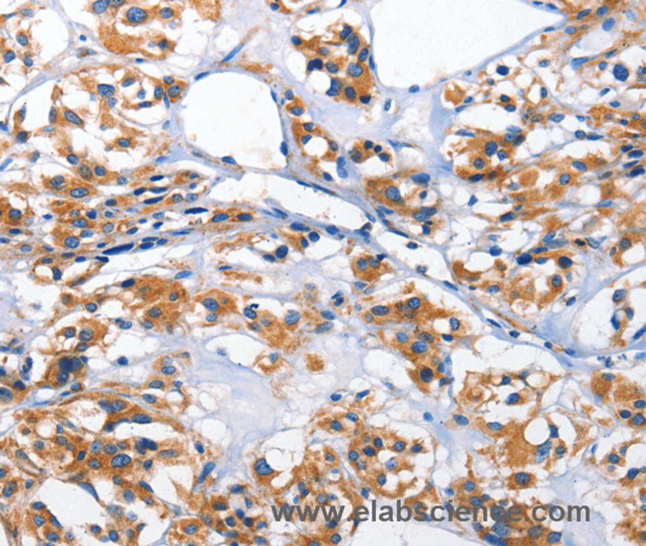 Immunohistochemistry of paraffin-embedded Human thyroid cancer tissue using HK2 Polyclonal Antibody at dilution 1:40