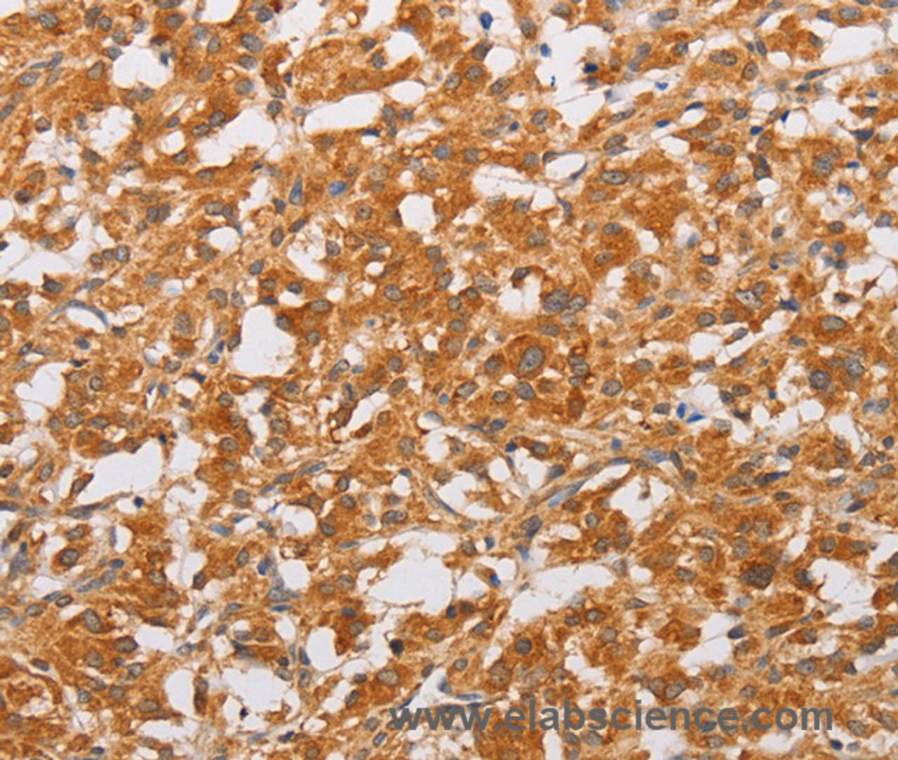 Immunohistochemistry of paraffin-embedded Human thyroid cancer tissue using OLR1 Polyclonal Antibody at dilution 1:50