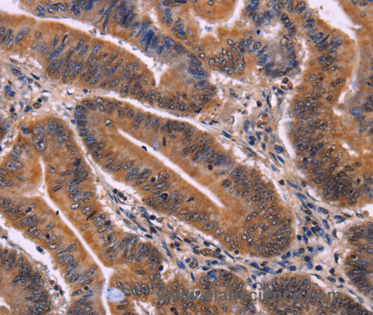 Immunohistochemistry of paraffin-embedded Human colon cancer tissue using CDC5L Polyclonal Antibody at dilution 1:40