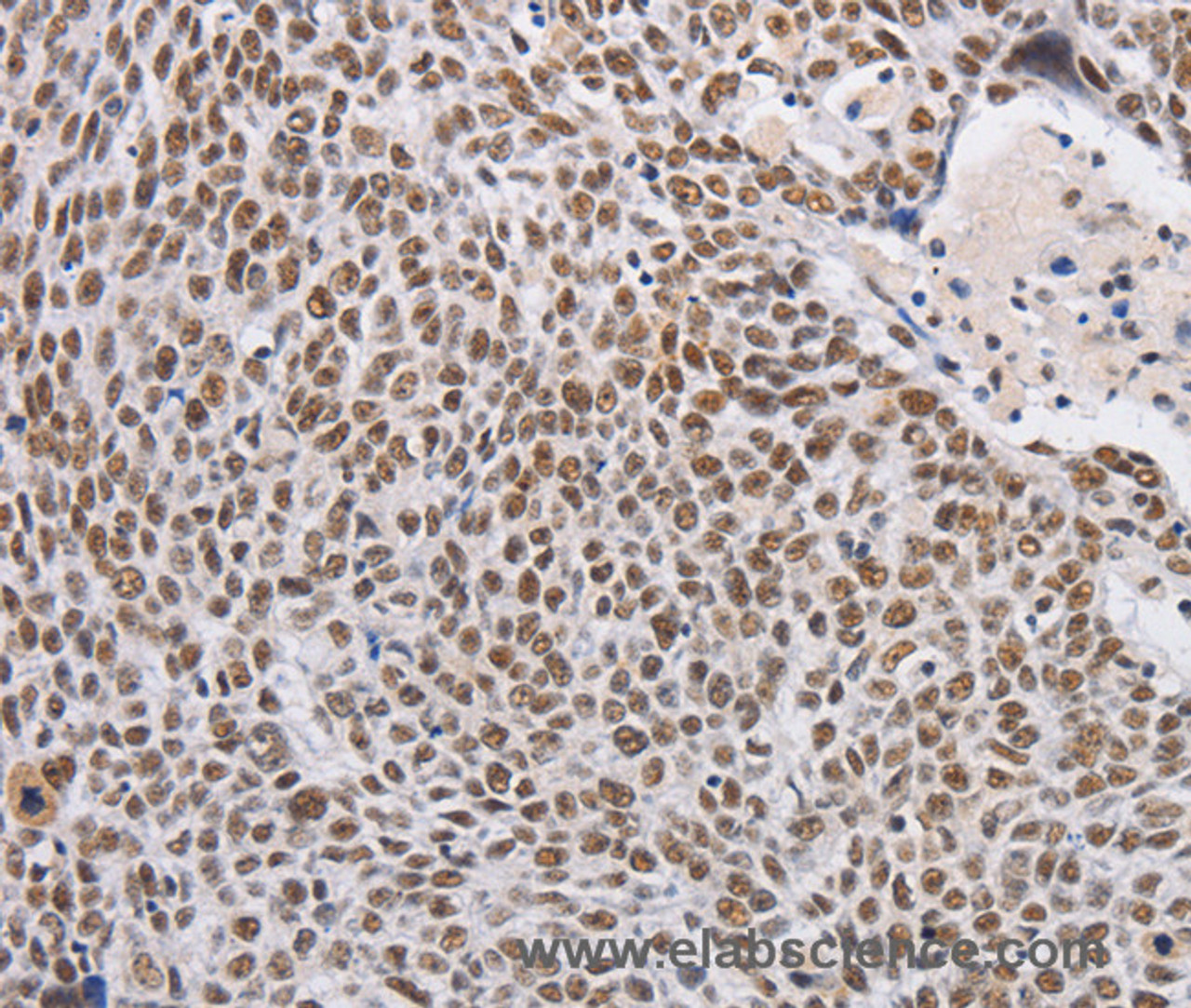 Immunohistochemistry of paraffin-embedded Human lung cancer using THOC7 Polyclonal Antibody at dilution of 1:30