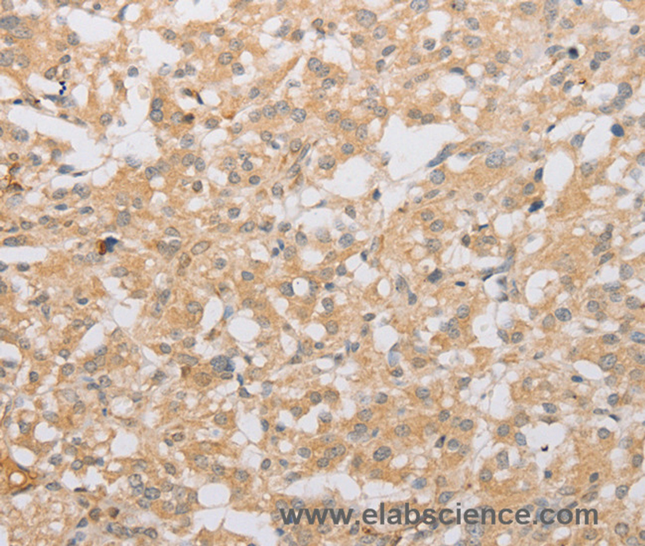 Immunohistochemistry of paraffin-embedded Human thyroid cancer tissue using ATG9A Polyclonal Antibody at dilution 1:40