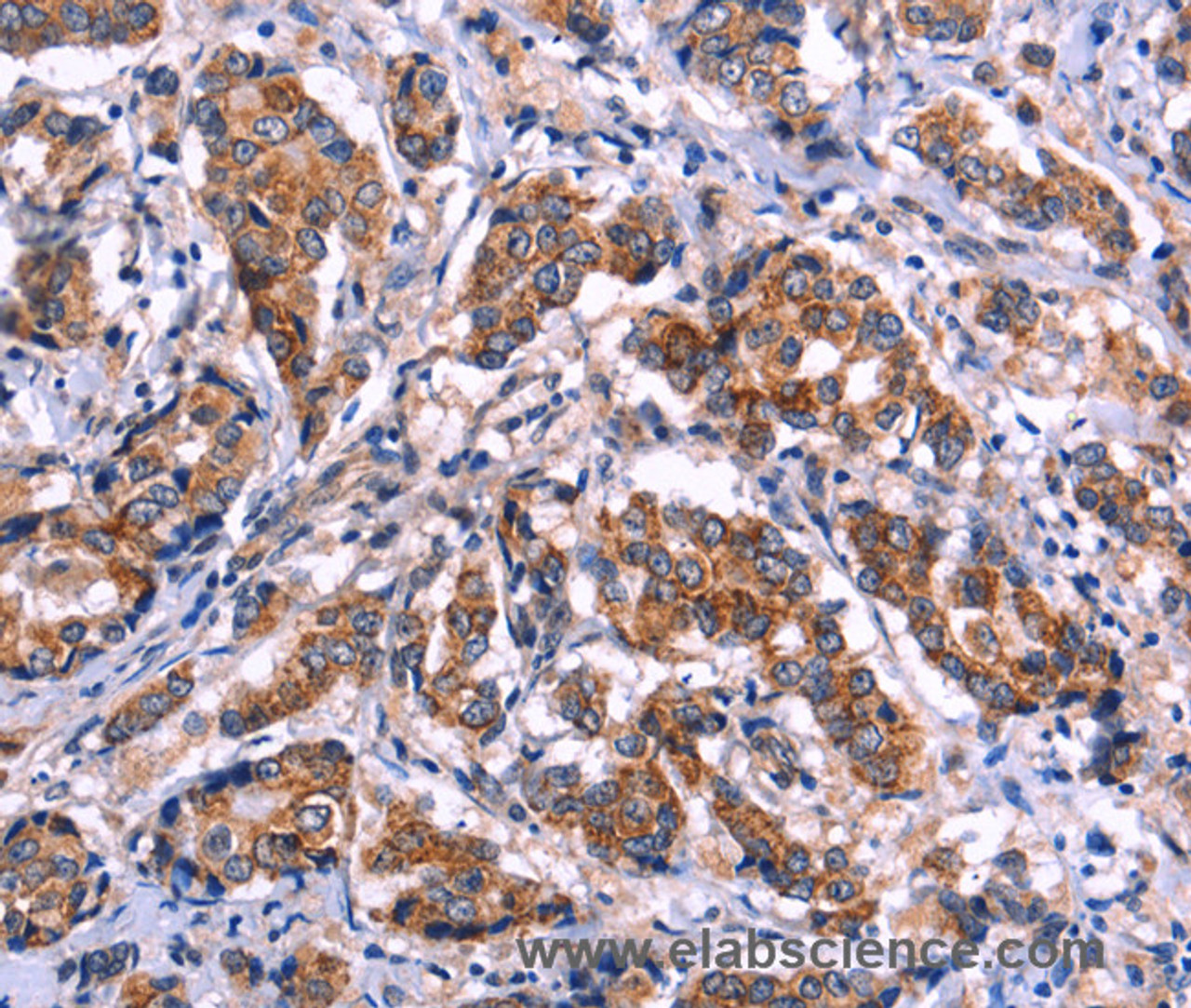 Immunohistochemistry of paraffin-embedded Human breast cancer tissue using EIF2AK4 Polyclonal Antibody at dilution 1:50