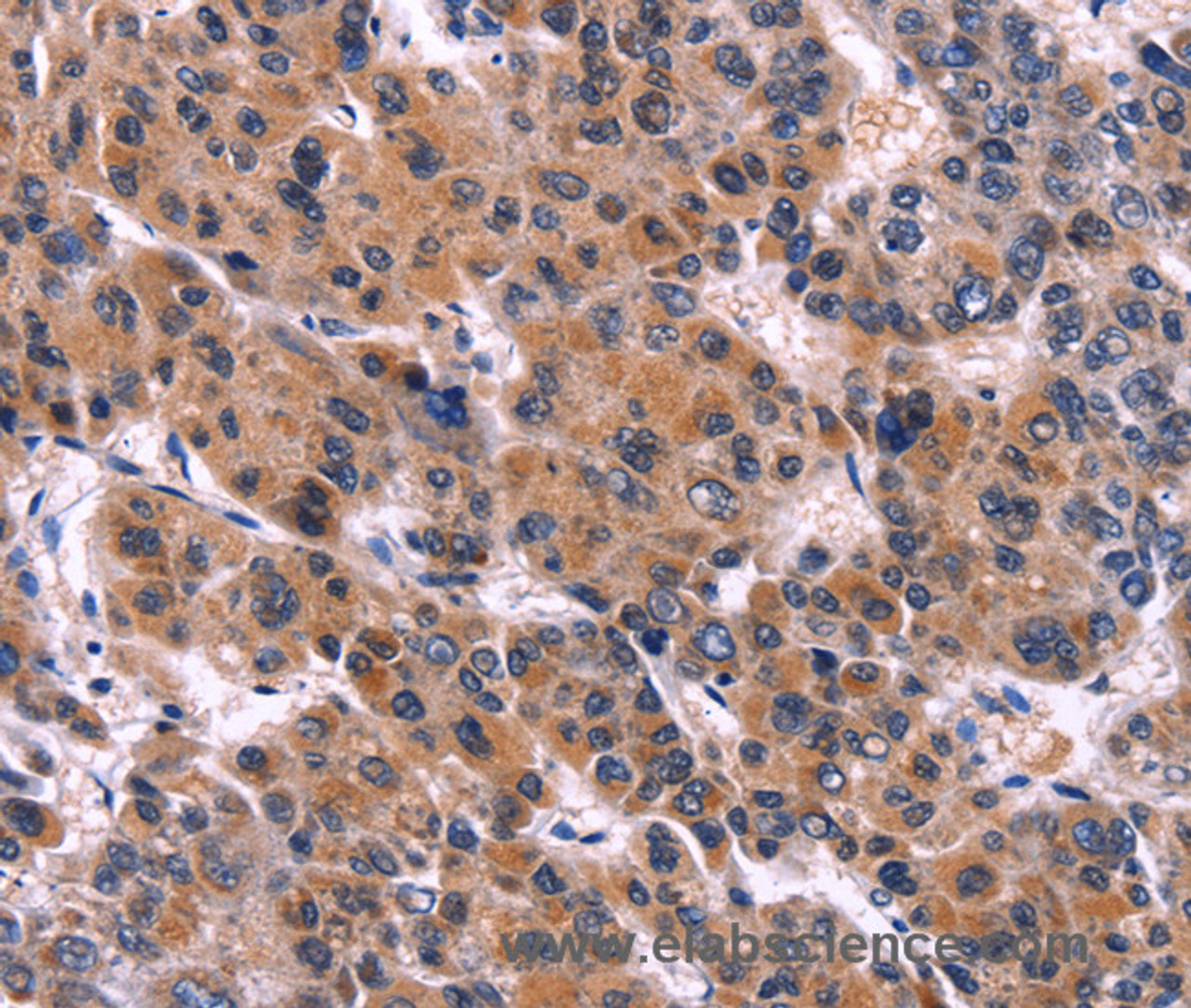 Immunohistochemistry of paraffin-embedded Human liver cancer tissue using EIF2AK4 Polyclonal Antibody at dilution 1:50