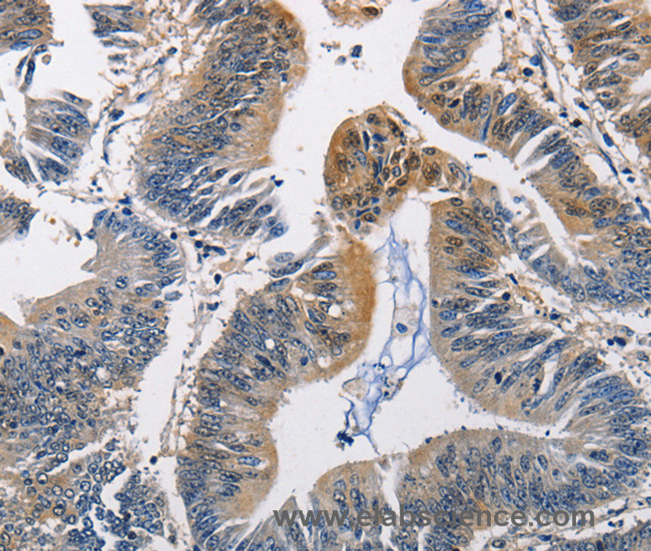 Immunohistochemistry of paraffin-embedded Human colon cancer using PGK1 Polyclonal Antibody at dilution of 1:50