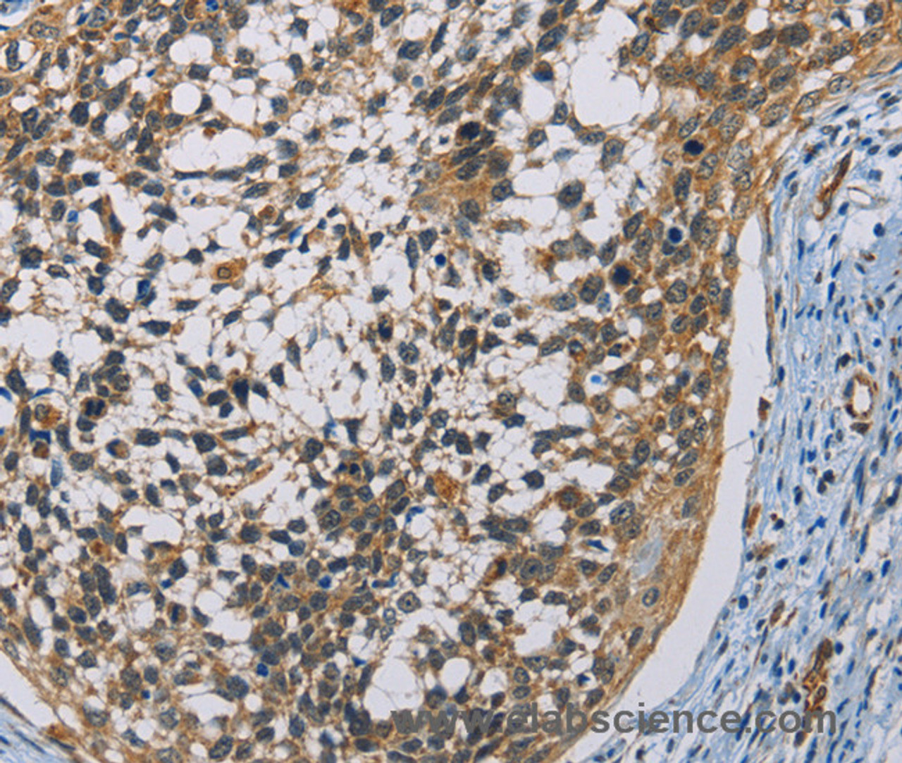 Immunohistochemistry of paraffin-embedded Human cervical cancer using CSNK1E Polyclonal Antibody at dilution of 1:60