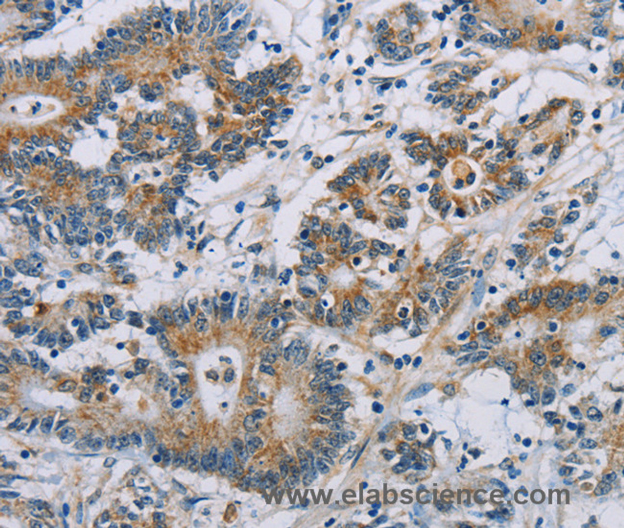 Immunohistochemistry of paraffin-embedded Human colon cancer using CSNK1E Polyclonal Antibody at dilution of 1:60