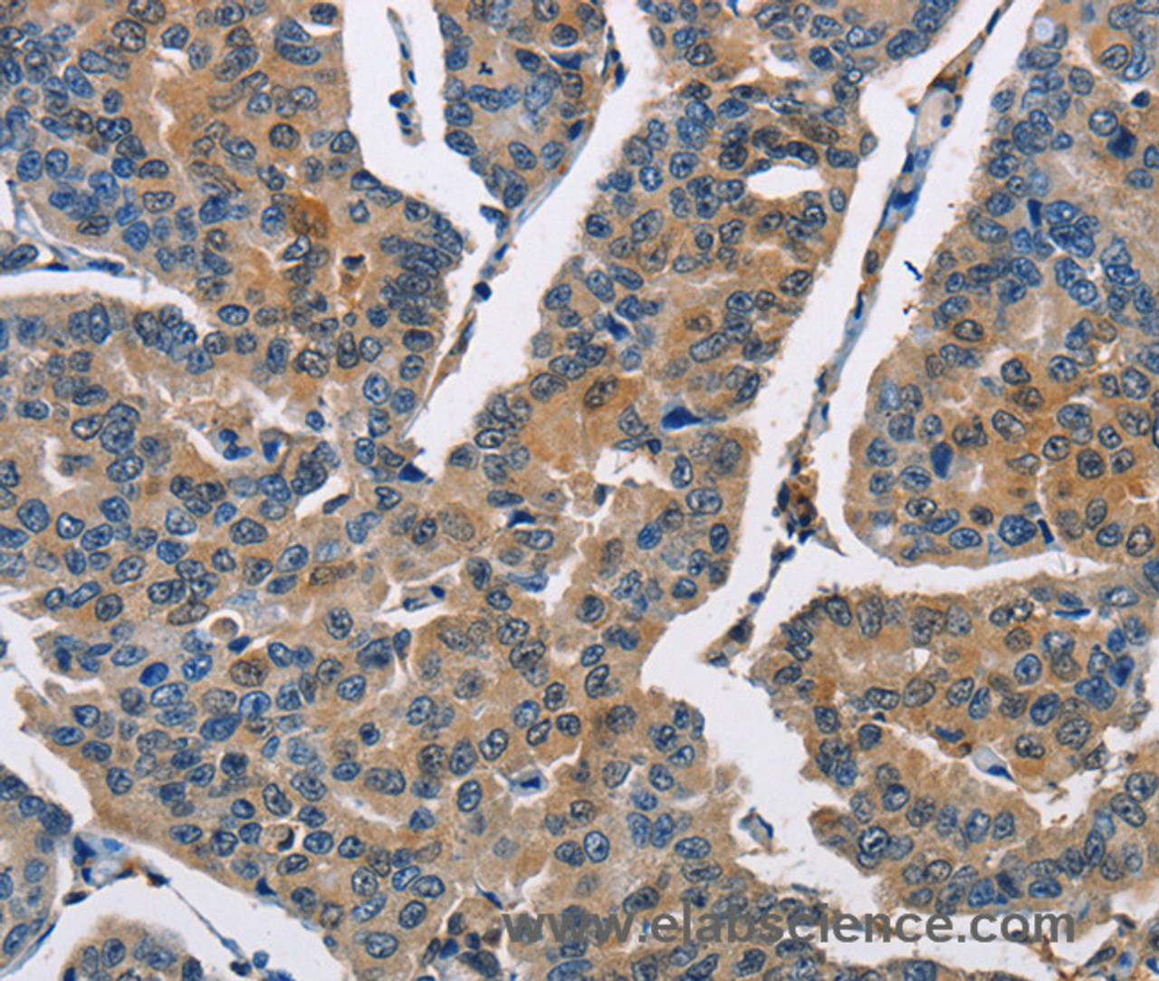 Immunohistochemistry of paraffin-embedded Human breast cancer using CBR1 Polyclonal Antibody at dilution of 1:40