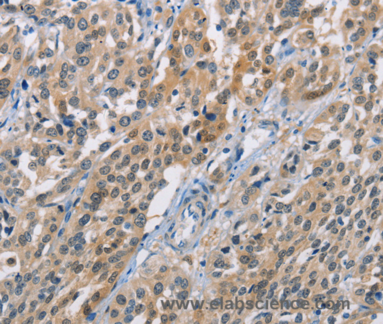 Immunohistochemistry of paraffin-embedded Human esophagus cancer using CBR1 Polyclonal Antibody at dilution of 1:40