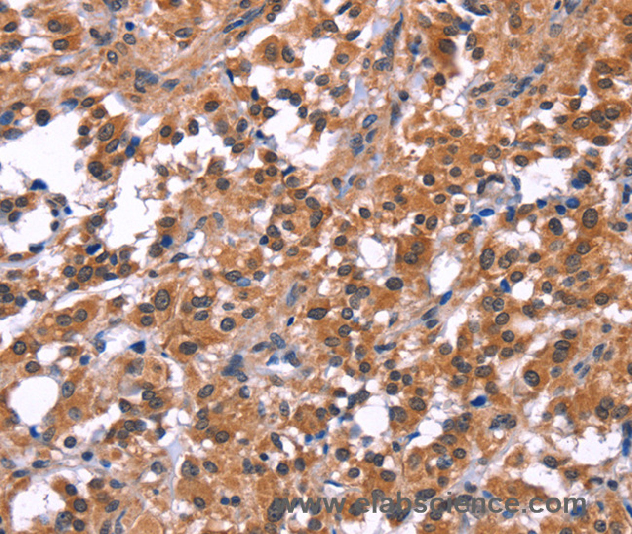Immunohistochemistry of paraffin-embedded Human thyroid cancer tissue using PIP5K1B Polyclonal Antibody at dilution 1:30