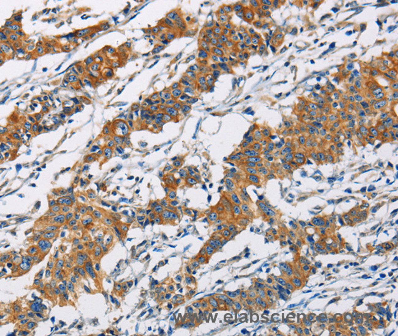 Immunohistochemistry of paraffin-embedded Human gastic cancer using PIP4K2A Polyclonal Antibody at dilution of 1:40