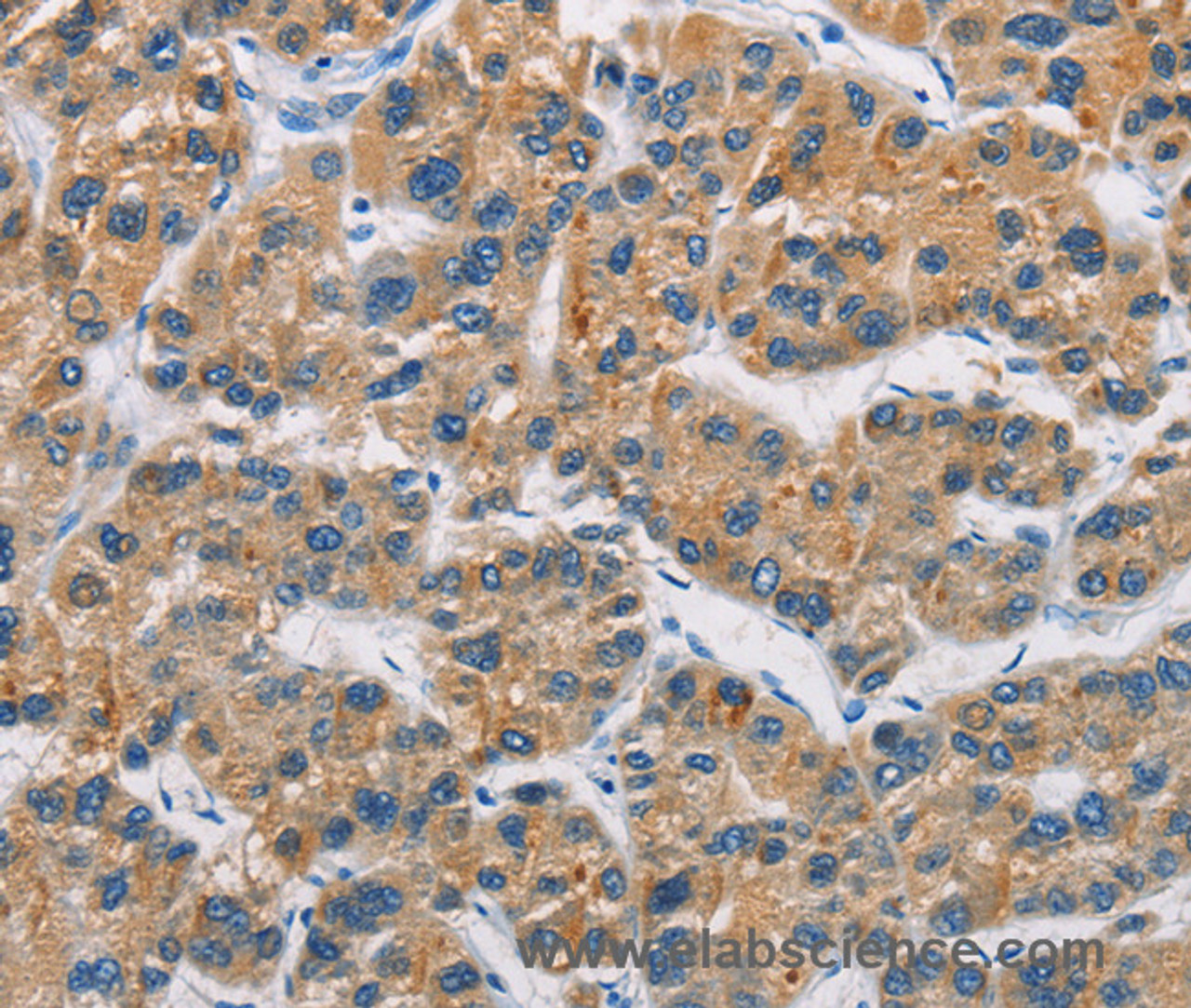 Immunohistochemistry of paraffin-embedded Human liver cancer tissue using CERK Polyclonal Antibody at dilution 1:30