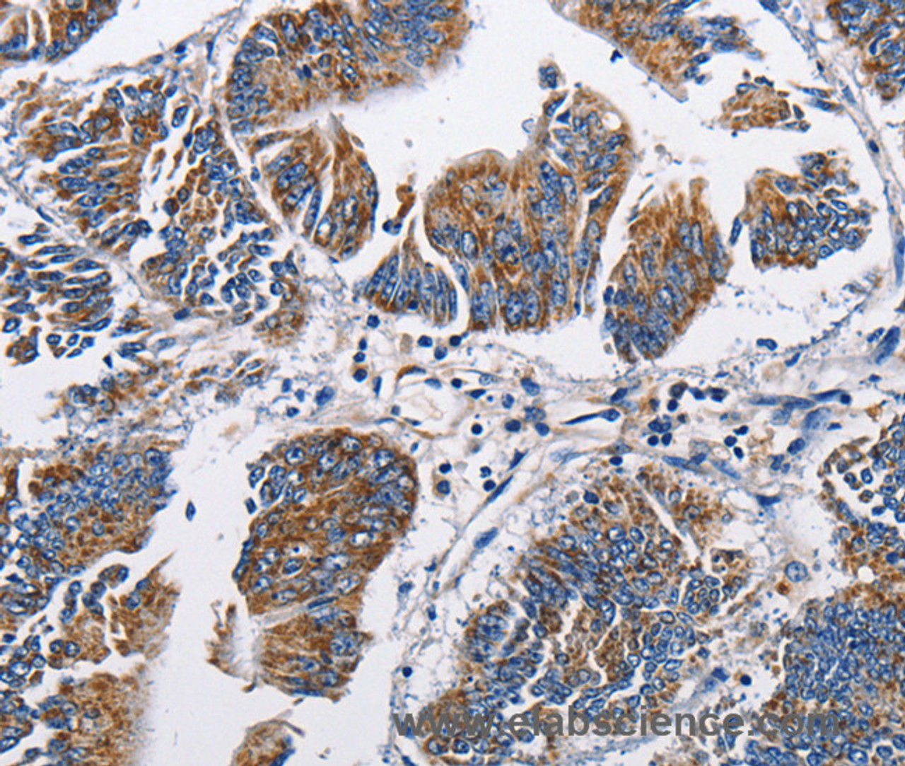 Immunohistochemistry of paraffin-embedded Human colon cancer tissue using NPPA Polyclonal Antibody at dilution 1:60