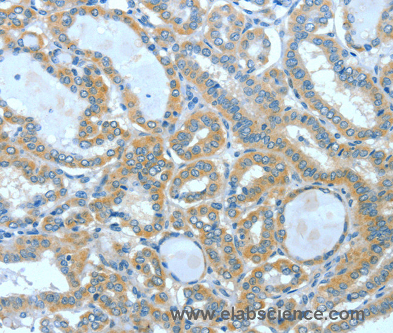 Immunohistochemistry of paraffin-embedded Human thyroid cancer using SPHK2 Polyclonal Antibody at dilution of 1:60