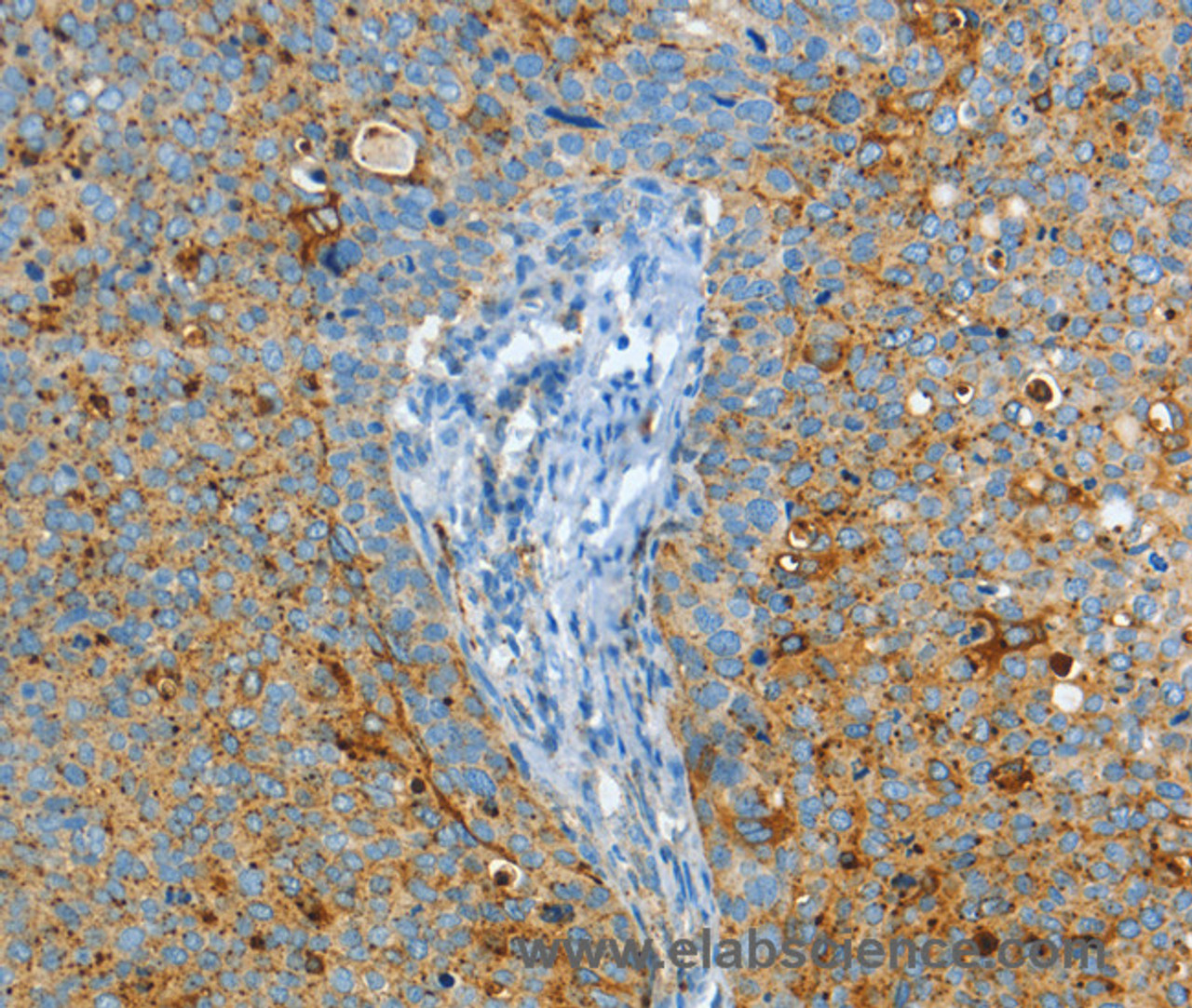 Immunohistochemistry of paraffin-embedded Human cervical cancer using ASAH1 Polyclonal Antibody at dilution of 1:50