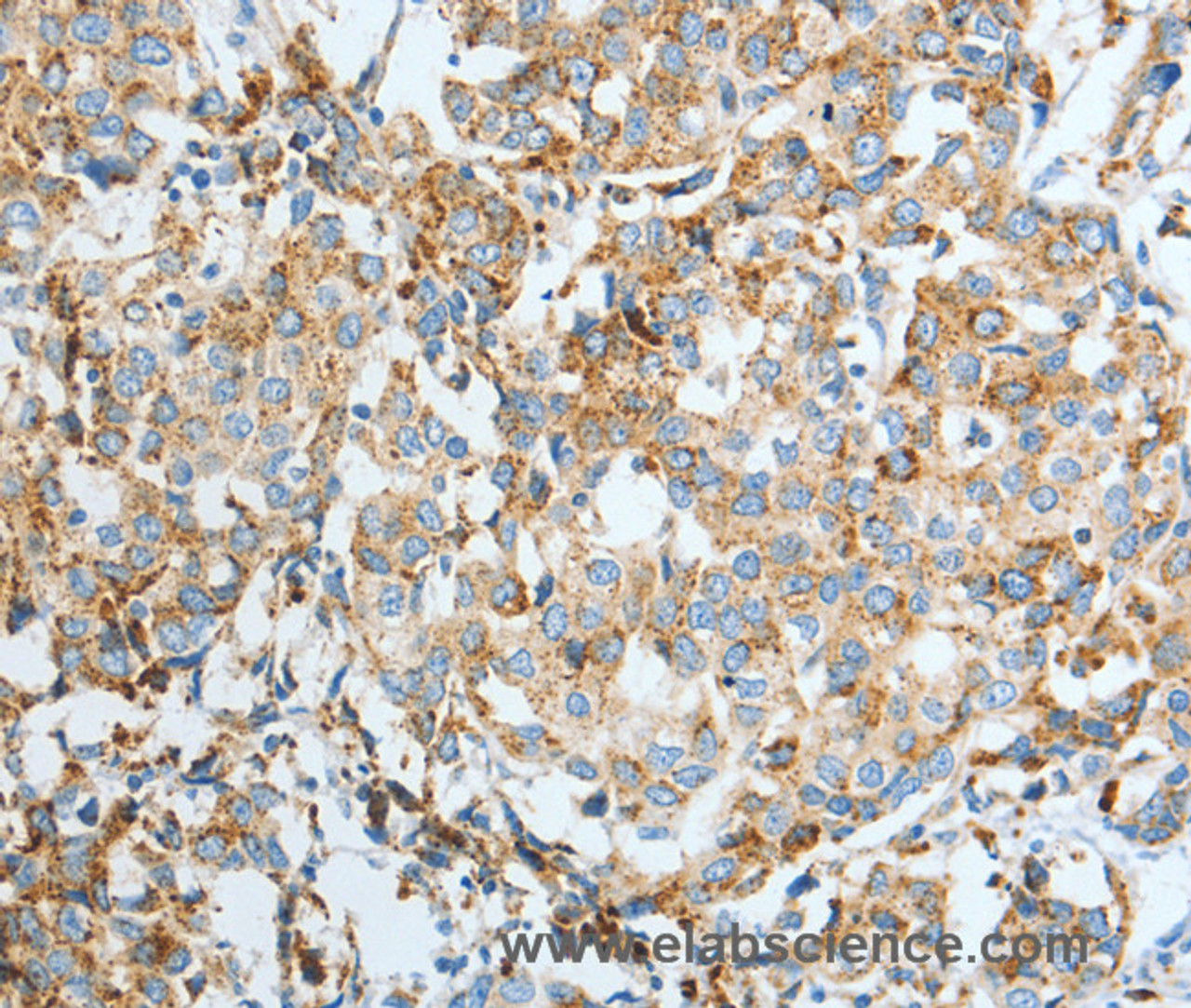 Immunohistochemistry of paraffin-embedded Human breast cancer using ASAH1 Polyclonal Antibody at dilution of 1:50