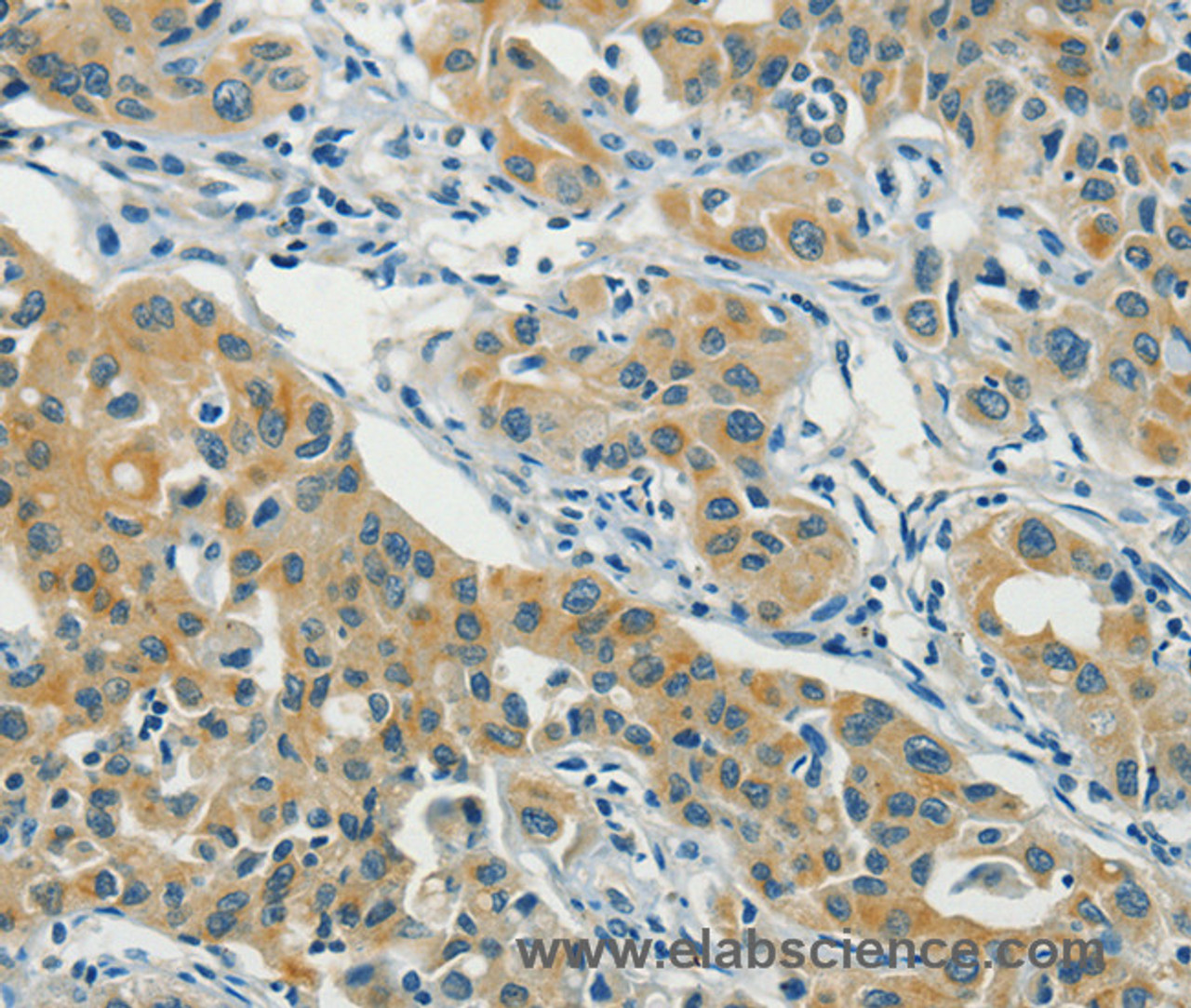 Immunohistochemistry of paraffin-embedded Human lung cancer using ASAH2 Polyclonal Antibody at dilution of 1:40